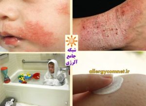 توصیه های مهم برای درمان اگزما - شبکه جامع آلرژی