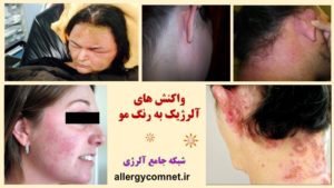 واکنش های آلرژیک به رنگ مو