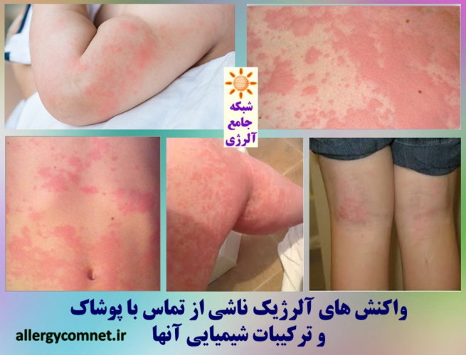 حساسیت و آلرژی به انواع پارچه و پوشاک ۲- شبکه جامع آلرژی