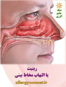 آلرژی بینی (رینیت آلرژیک) یا سینوزیت- ۱ شبکه جامع آلرژی