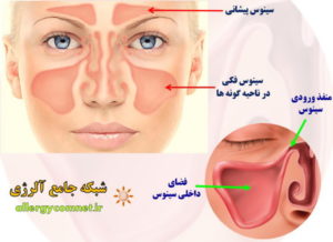 آلرژی بینی (رینیت آلرژیک) یا سینوزیت- ۲ شبکه جامع آلرژی