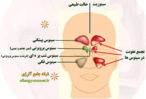 آلرژی بینی (رینیت آلرژیک) یا سینوزیت- ۲ شبکه جامع آلرژی